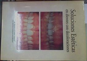 Soluciones estéticas en dientes con decoloraciones | 154607 | Anitua Aldecoa, Eduardo de/Gascón Mayordomo, Francisco